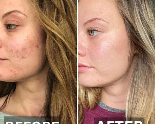 SkinRelief™ - Effektive Hautstraffung