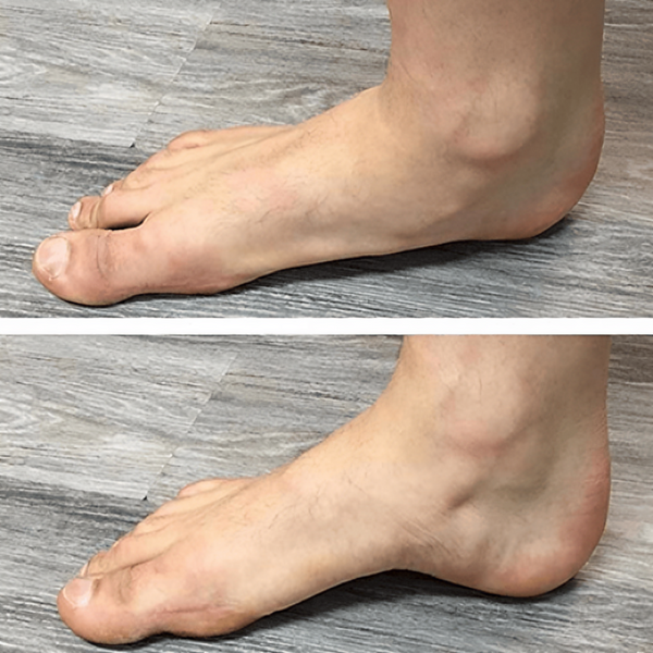 1+1 Gratis | SohlenEntlastung™ Sofortige Linderung von Fußschmerzen